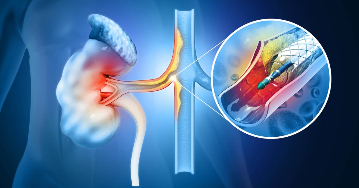 Böbrek Kanalında Daralma Neden Olur?