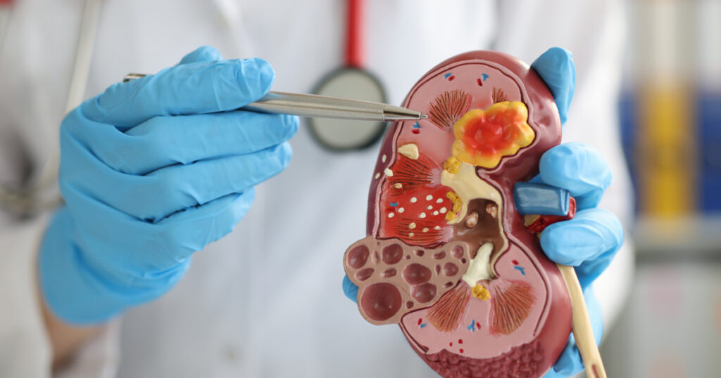 Üroloji Böbrek Yetmezliğine Bakar mı?