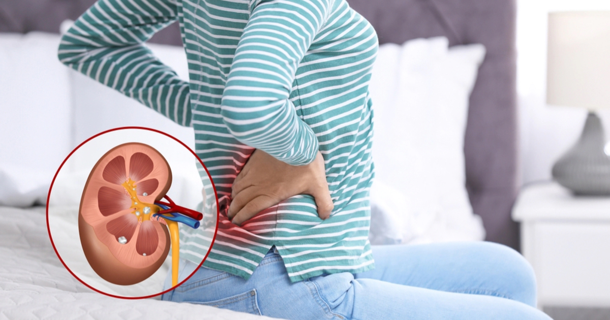 Böbrek Taşı Belirtileri: Taş Ne Zaman Müdahale Gerektirir?