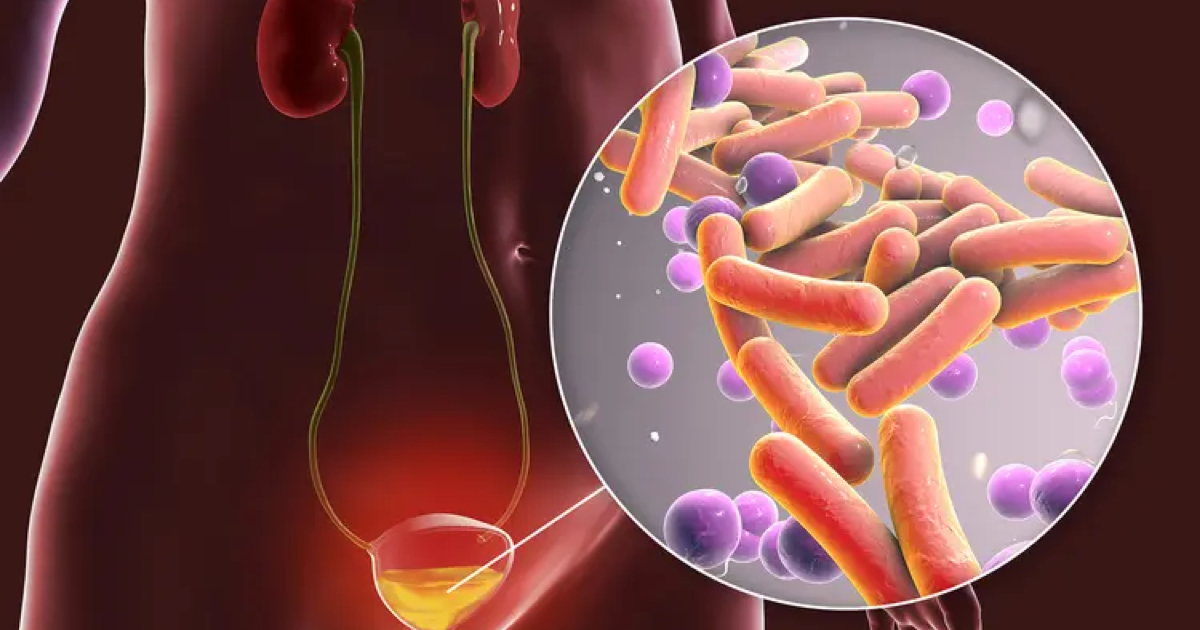 Çocuklarda İdrar Yolu Enfeksiyonu Neden Olur, Nasıl Anlaşılır?