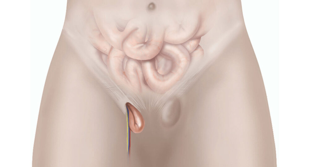 Çocuklarda Kasık Fıtığı Belirtileri