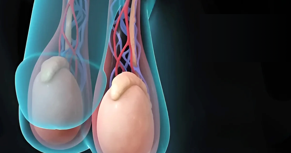 Çocuklarda Varikoselde Hangi Durumlarda Tedavi Gerekir?