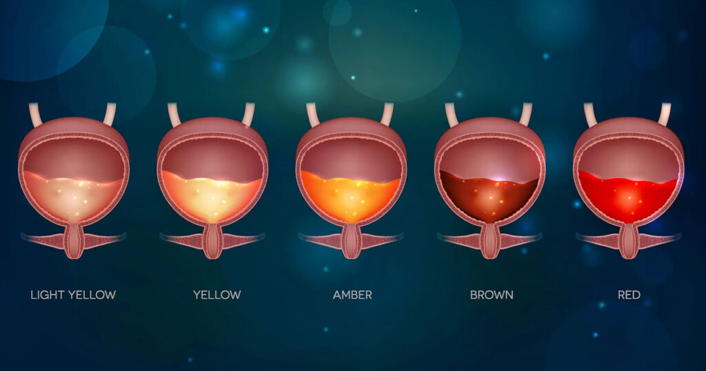 İdrarda Kan (Hematüri) Neden Olur? Hangi Durumlar Acildir?