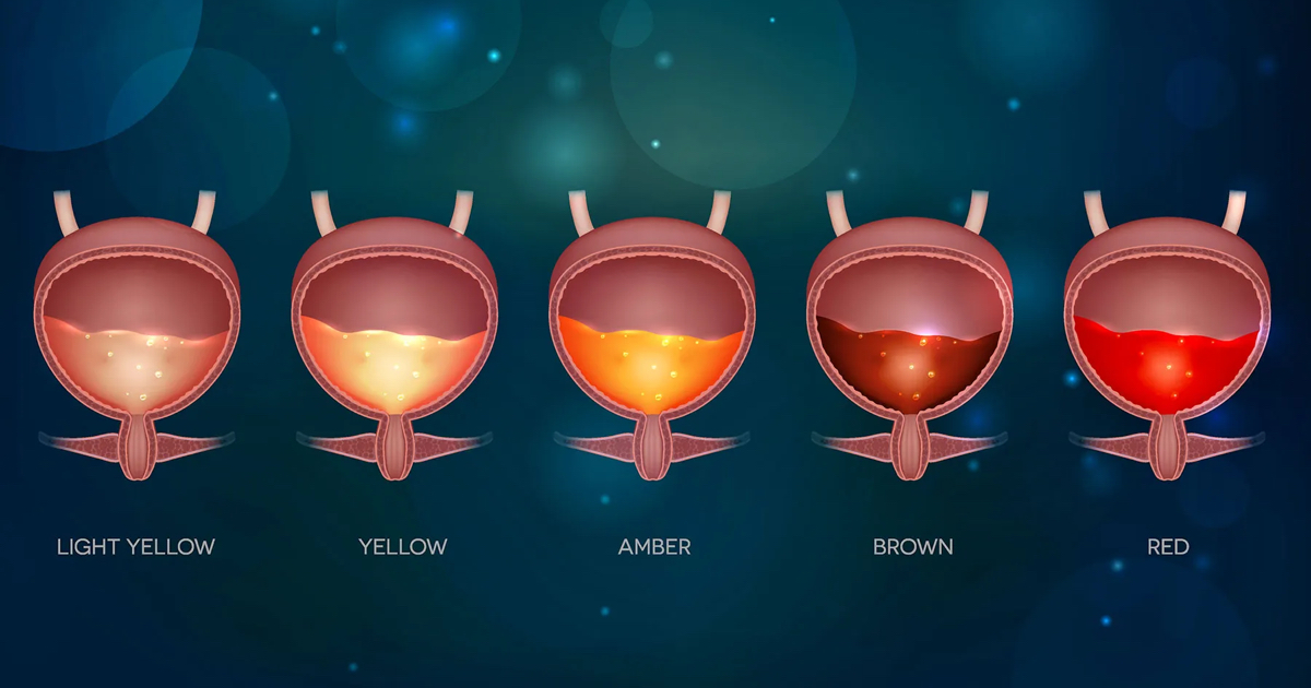 İdrarda Kan (Hematüri) Neden Olur? Hangi Durumlar Acildir?