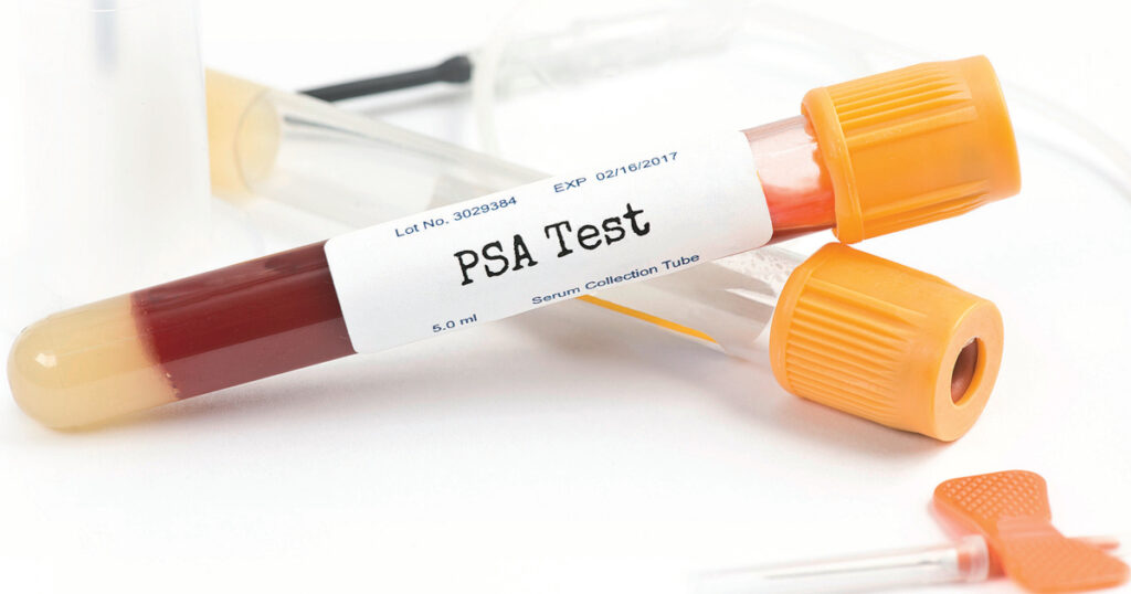 PSA Yüksekliği Ne Demek? Ne Zaman Biyopsi Gerekir?