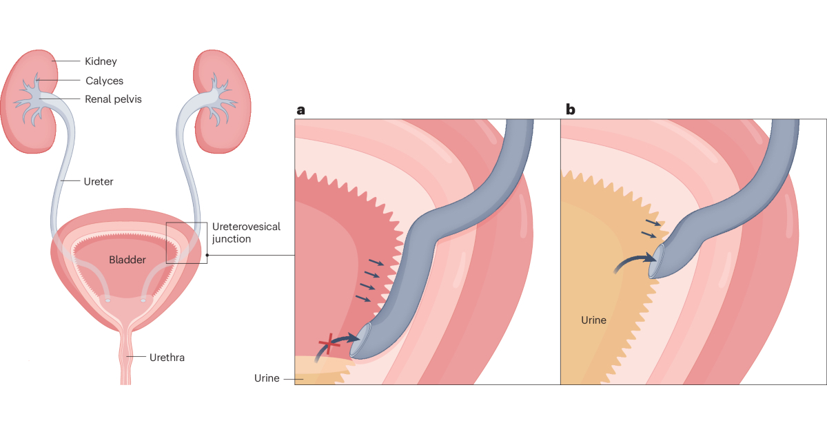 Vezikoüreteral Reflü (VUR) Belirtileri ve Tedavisi