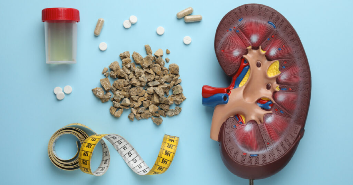 Böbrek Taşı Tekrarlar mı? Nasıl Önlenir?