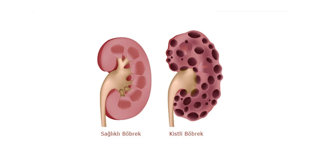 Böbrek Kisti Nedir? Tehlikeli midir?